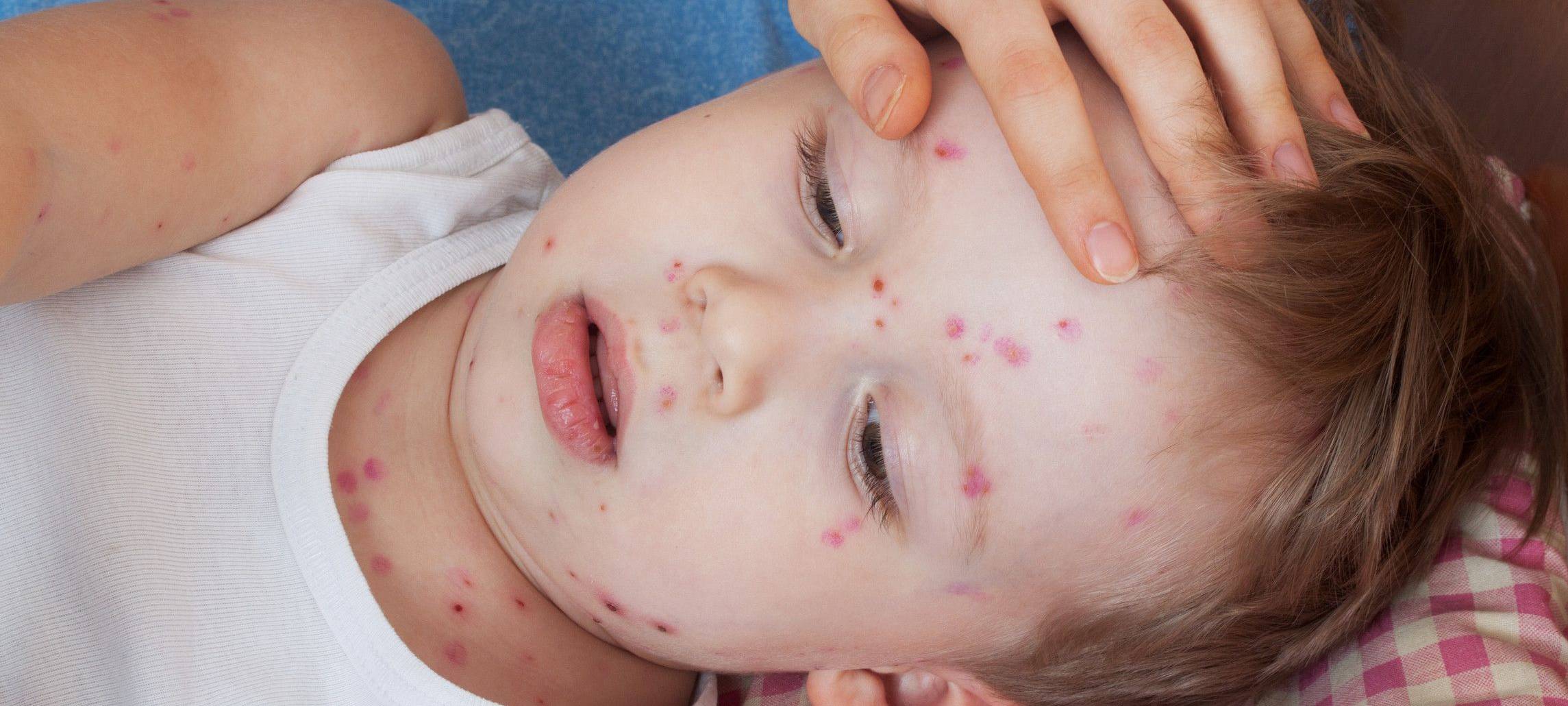 Mehr Windpocken im Märkischen Kreis